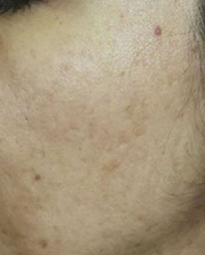 Registro posterior do caso PRP 5